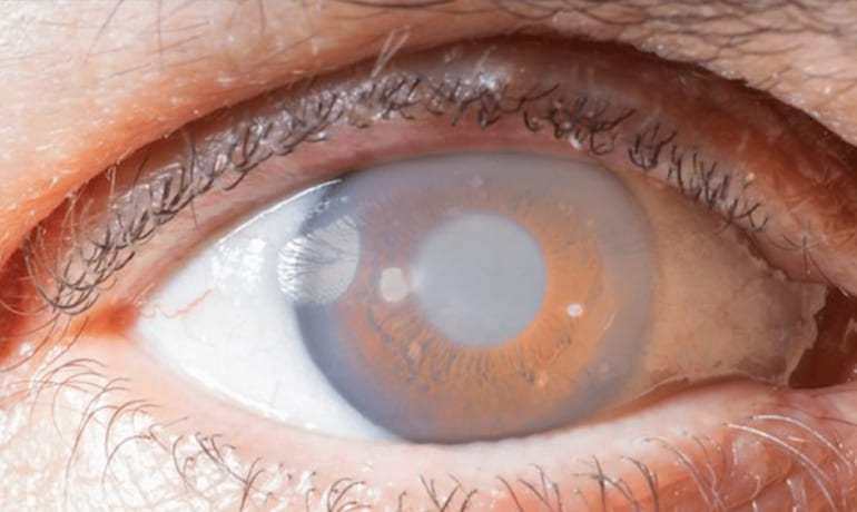 Detección y tratamiento de Glaucoma